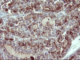 IL1A / IL-1 Alpha Antibody - IHC of paraffin-embedded Carcinoma of Human thyroid tissue using anti-IL1A mouse monoclonal antibody. (Heat-induced epitope retrieval by 10mM citric buffer, pH6.0, 120°C for 3min).
