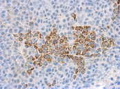 IL1F9 Antibody - IHC of paraffin-embedded HeLa xenograft using IL1F9 antibody antibody at 1:500 dilution.