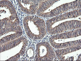 IL1F9 Antibody - IHC of paraffin-embedded Adenocarcinoma of Human endometrium tissue using anti-IL1F9 mouse monoclonal antibody.