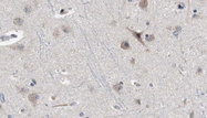 IL1RAPL2 Antibody - 1:100 staining human brain carcinoma tissue by IHC-P. The sample was formaldehyde fixed and a heat mediated antigen retrieval step in citrate buffer was performed. The sample was then blocked and incubated with the antibody for 1.5 hours at 22°C. An HRP conjugated goat anti-rabbit antibody was used as the secondary.