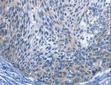 IL2RB / CD122 Antibody - Immunohistochemistry of paraffin-embedded Human cervical cancer using IL2RB Polyclonal Antibody at dilution of 1:30.