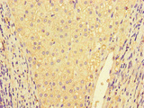 IL32 Antibody - Immunohistochemistry of paraffin-embedded human liver cancer at dilution of 1:100