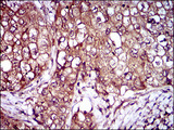 IL3RA / CD123 Antibody - IHC of paraffin-embedded lung cancer tissues using IL3RA mouse monoclonal antibody with DAB staining.