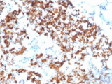 IL3RA / CD123 Antibody - IHC staining of FFPE human gastric carcinoma with CD123 antibody. HIER: boil tissue sections in 10mM Tris with 1mM EDTA, pH 9 for 10-20 min and allow to cool.