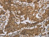 IL5RA / CD125 Antibody - Immunohistochemistry of paraffin-embedded Human gastric cancer using IL5RA Polyclonal Antibody at dilution of 1:40.