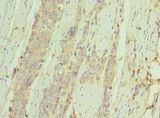 IL7R / CD127 Antibody - Immunohistochemistry of paraffin-embedded human rectal cancer using antibody at 1:100 dilution.