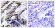 ILKAP Antibody - Immunohistochemistry analysis of paraffin-embedded human colon carcinoma tissue, using ILKAP Antibody. The picture on the right is blocked with the synthesized peptide.
