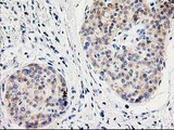 ILVBL Antibody - IHC of paraffin-embedded Carcinoma of Human pancreas tissue using anti-ILVBL mouse monoclonal antibody.