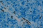 Melanoma: Anti-Vimentin (rabbit mab), ImmPRESS-AP Anti-Rabbit IgG, Vector Blue™ Substrate (blue).