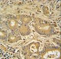 IMMT / Mitofilin Antibody - IMMT Antibody immunohistochemistry of formalin-fixed and paraffin-embedded human colon carcinoma followed by peroxidase-conjugated secondary antibody and DAB staining.