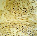 IMP4 Antibody - IMP4 Antibody IHC of formalin-fixed and paraffin-embedded human testis carcinoma followed by peroxidase-conjugated secondary antibody and DAB staining.