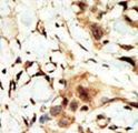 INSR / Insulin Receptor Antibody - Formalin-fixed and paraffin-embedded human cancer tissue reacted with the primary antibody, which was peroxidase-conjugated to the secondary antibody, followed by DAB staining. This data demonstrates the use of this antibody for immunohistochemistry; clinical relevance has not been evaluated. BC = breast carcinoma; HC = hepatocarcinoma.