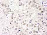 INT7 / INTS7 Antibody - Detection of Human INT7 by Immunohistochemistry. Sample: FFPE section of human breast carcinoma Antibody: Affinity purified rabbit anti-INT7 used at a dilution of 1:250.
