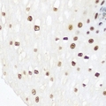 INTS5 Antibody - Immunohistochemical analysis of INTS5 staining in human esophageal cancer formalin fixed paraffin embedded tissue section. The section was pre-treated using heat mediated antigen retrieval with sodium citrate buffer (pH 6.0). The section was then incubated with the antibody at room temperature and detected using an HRP conjugated compact polymer system. DAB was used as the chromogen. The section was then counterstained with hematoxylin and mounted with DPX.