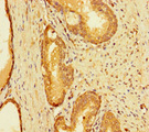 INTS9 Antibody - Immunohistochemistry of paraffin-embedded human prostate cancer at dilution of 1:100