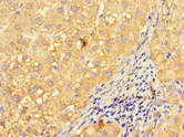 INVS / Inversin Antibody - Immunohistochemistry of paraffin-embedded human liver cancer at dilution 1:100