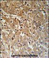 IPO8 / Importin 8 Antibody - IPO8 Antibody (N-term) IHC of formalin fixed and paraffin embedded human cervix carcinoma followed by peroxidase conjugation of the secondary antibody and DAB staining. This demonstrates the use of the IPO8 Antibody (N-term) for immunohistochemistry.