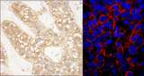 IQGAP1 Antibody - Detection of Human IQGAP1 by Immunohistochemistry and Immunofluorescence. Sample: FFPE sections of human breast carcinoma. Antibody: Affinity purified rabbit anti-IQGAP1 used at a dilution of 1:1000 (0.2 ug/ml) and 1:200 (1 ug/ml). Detection: DAB and Red-fluorescent Goat anti-Rabbit IgG-heavy and light chain, cross-adsorbed Antibody DyLight 594 Conjugated used at a dilution of 1:100.