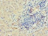IRAK2 / IRAK-2 Antibody - Immunohistochemistry of paraffin-embedded human liver cancer using antibody at 1:100 dilution.