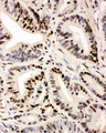 IRF1 / MAR Antibody - IRF1 / IRF-1 /MAR antibody. IHC(P): Human Intestinal Cancer Tissue.