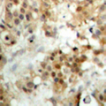 IRF3 Antibody - Immunohistochemical analysis of IRF3 staining in human breast cancer formalin fixed paraffin embedded tissue section. The section was pre-treated using heat mediated antigen retrieval with sodium citrate buffer (pH 6.0). The section was then incubated with the antibody at room temperature and detected using an HRP conjugated compact polymer system. DAB was used as the chromogen. The section was then counterstained with hematoxylin and mounted with DPX.