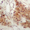 IRF3 Antibody - Immunohistochemical analysis of IRF3 (pS385) staining in human breast cancer formalin fixed paraffin embedded tissue section. The section was pre-treated using heat mediated antigen retrieval with sodium citrate buffer (pH 6.0). The section was then incubated with the antibody at room temperature and detected using an HRP polymer system. DAB was used as the chromogen. The section was then counterstained with hematoxylin and mounted with DPX.