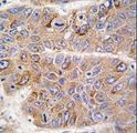 IRS2 / IRS-2 Antibody - Formalin-fixed and paraffin-embedded human hepatocarcinoma tissue reacted with IRS2 antibody , which was peroxidase-conjugated to the secondary antibody, followed by DAB staining. This data demonstrates the use of this antibody for immunohistochemistry; clinical relevance has not been evaluated.