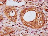 IRX6 Antibody - Immunohistochemistry Dilution at 1:200 and staining in paraffin-embedded human cervical cancer performed on a Leica BondTM system. After dewaxing and hydration, antigen retrieval was mediated by high pressure in a citrate buffer (pH 6.0). Section was blocked with 10% normal Goat serum 30min at RT. Then primary antibody (1% BSA) was incubated at 4°C overnight. The primary is detected by a biotinylated Secondary antibody and visualized using an HRP conjugated SP system.