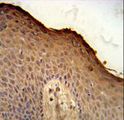 ISM1 Antibody - ISM1 Antibody immunohistochemistry of formalin-fixed and paraffin-embedded human skin carcinoma followed by peroxidase-conjugated secondary antibody and DAB staining.