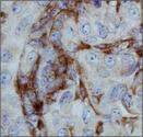 ITGAM / CD11b Antibody - CD11b Antibody - Microglia Marker - IHC of CD11b in human renal cancer using DAB with hematoxylin counterstain.  This image was taken for the unconjugated form of this product. Other forms have not been tested.