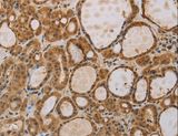 ITIH1 Antibody - Immunohistochemistry of paraffin-embedded Human thyroid cancer using ITIH1 Polyclonal Antibody at dilution of 1:30.