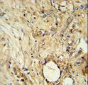 ITIH5 Antibody - ITIH5 Antibody immunohistochemistry of formalin-fixed and paraffin-embedded human breast carcinoma followed by peroxidase-conjugated secondary antibody and DAB staining.
