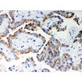 ITPR3 Antibody - ITPR3 antibody IHC-paraffin. IHC(P): Human Lung Cancer Tissue.