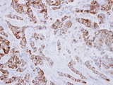 IVD Antibody - IHC of paraffin-embedded Breast ca using IVD antibody at 1:250 dilution.
