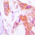 IVL / Involucrin Antibody - Immunohistochemical analysis of Involucrin staining in human lung cancer formalin fixed paraffin embedded tissue section. The section was pre-treated using heat mediated antigen retrieval with sodium citrate buffer (pH 6.0). The section was then incubated with the antibody at room temperature and detected using an HRP conjugated compact polymer system. DAB was used as the chromogen. The section was then counterstained with hematoxylin and mounted with DPX.