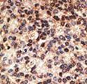 JAG2 / Jagged-2 Antibody - Formalin-fixed and paraffin-embedded human cancer tissue reacted with the primary antibody, which was peroxidase-conjugated to the secondary antibody, followed by DAB staining. This data demonstrates the use of this antibody for immunohistochemistry; clinical relevance has not been evaluated. BC = breast carcinoma; HC = hepatocarcinoma.