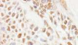 JMJD1C Antibody - Detection of Human JMJD1C by Immunohistochemistry. Sample: FFPE section of human laryngeal squamous cell carcinoma. Antibody: Affinity purified rabbit anti-JMJD1C used at a dilution of 1:1000 (1 ug/ml). Detection: DAB.