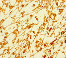 JMJD1C Antibody - Immunohistochemistry of paraffin-embedded human melanoma cancer at dilution of 1:100
