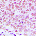 JUN / c-Jun Antibody - Immunohistochemical analysis of c-Jun staining in human breast cancer formalin fixed paraffin embedded tissue section. The section was pre-treated using heat mediated antigen retrieval with sodium citrate buffer (pH 6.0). The section was then incubated with the antibody at room temperature and detected using an HRP conjugated compact polymer system. DAB was used as the chromogen. The section was then counterstained with hematoxylin and mounted with DPX.