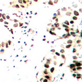 JUN / c-Jun Antibody - Immunohistochemical analysis of c-Jun (pT239) staining in human breast cancer formalin fixed paraffin embedded tissue section. The section was pre-treated using heat mediated antigen retrieval with sodium citrate buffer (pH 6.0). The section was then incubated with the antibody at room temperature and detected using an HRP conjugated compact polymer system. DAB was used as the chromogen. The section was then counterstained with hematoxylin and mounted with DPX.