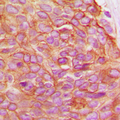 JUP/CTNNG/Junction Plakoglobin Antibody - Immunohistochemical analysis of Gamma-catenin staining in human breast cancer formalin fixed paraffin embedded tissue section. The section was pre-treated using heat mediated antigen retrieval with sodium citrate buffer (pH 6.0). The section was then incubated with the antibody at room temperature and detected using an HRP conjugated compact polymer system. DAB was used as the chromogen. The section was then counterstained with hematoxylin and mounted with DPX.
