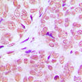 KAT2B / PCAF Antibody - Immunohistochemical analysis of PCAF staining in human breast cancer formalin fixed paraffin embedded tissue section. The section was pre-treated using heat mediated antigen retrieval with sodium citrate buffer (pH 6.0). The section was then incubated with the antibody at room temperature and detected using an HRP conjugated compact polymer system. DAB was used as the chromogen. The section was then counterstained with hematoxylin and mounted with DPX.