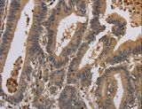 KCNA7 / Kv1.7 Antibody - Immunohistochemistry of paraffin-embedded Human colon cancer using KCNA7 Polyclonal Antibody at dilution of 1:40.