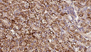 KCNE3 Antibody - 1:100 staining human liver carcinoma tissues by IHC-P. The sample was formaldehyde fixed and a heat mediated antigen retrieval step in citrate buffer was performed. The sample was then blocked and incubated with the antibody for 1.5 hours at 22°C. An HRP conjugated goat anti-rabbit antibody was used as the secondary.