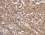 KCNG2 Antibody - Immunohistochemistry of paraffin-embedded Human liver cancer using KCNG2 Polyclonal Antibody at dilution of 1:40.