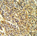 KCNJ2 / Kir2.1 Antibody - Formalin-fixed and paraffin-embedded human lung carcinoma reacted with KCNJ2 Antibody , which was peroxidase-conjugated to the secondary antibody, followed by DAB staining. This data demonstrates the use of this antibody for immunohistochemistry; clinical relevance has not been evaluated.
