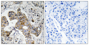 KCNK15 Antibody - Immunohistochemistry analysis of paraffin-embedded human breast carcinoma tissue, using KCNK15 Antibody. The picture on the right is blocked with the synthesized peptide.