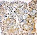 KCNMA1 / BK Antibody - KCNMA1antibody IHC-paraffin: Human Lung Cancer Tissue.