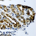 KCNN3 / SK3 Antibody - Immunohistochemical analysis of KCNN3 staining in human gastric cancer formalin fixed paraffin embedded tissue section. The section was pre-treated using heat mediated antigen retrieval with sodium citrate buffer (pH 6.0). The section was then incubated with the antibody at room temperature and detected using an HRP conjugated compact polymer system. DAB was used as the chromogen. The section was then counterstained with hematoxylin and mounted with DPX.