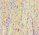 KCTD16 Antibody - Immunohistochemistry of paraffin-embedded human liver cancer using KCTD16 Antibody at dilution of 1:100